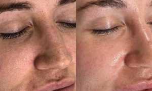 Что такое молочный пилинг для лица и как его применять не только в косметологии, но и в домашних условиях для достижения лучших результатов