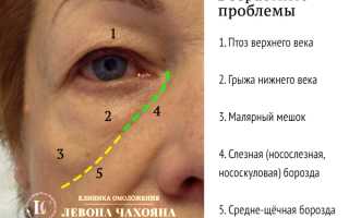 Все причины, почему появляются большие мешки под глазами у женщин и о чем они сигнализируют, а также советы по уходу