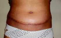 Серома послеоперационного шва. Что это такое: после кесарева, мастэктомии, фиброаденоме молочной железы. Лечение народными средствами, препараты