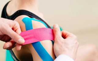 Кинезиотейпирование – чудесные ленточки, которые помогут вам избавиться от последствий травмы и восстановить здоровье