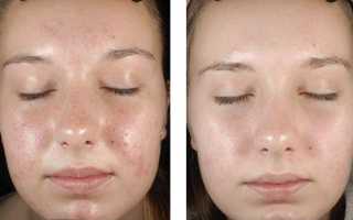 Находка косметологов — миндальный пилинг для лица. Что это такое и почему о нем только положительные отзывы? Узнайте все детали!