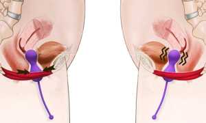 Для чего нужны вагинальные тренажеры Кегеля? Принцип работы и инструкция по применению для женщин